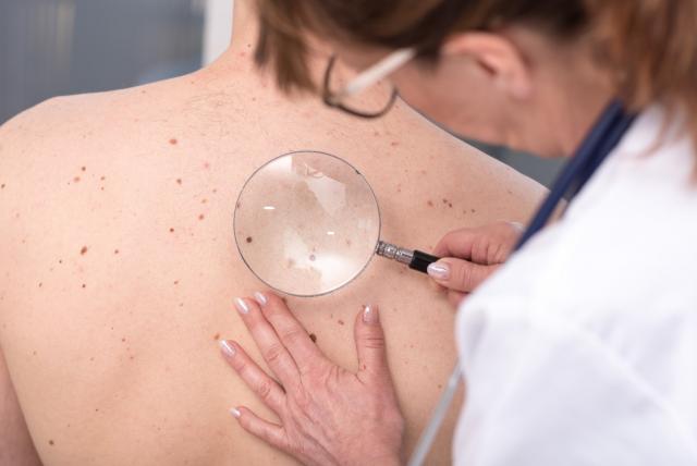 Poco más de 9 mil casos de melanoma fueron tratados durante el año pasado